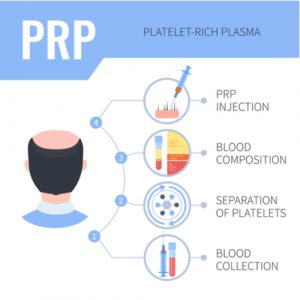 PRP for Hair Restoration