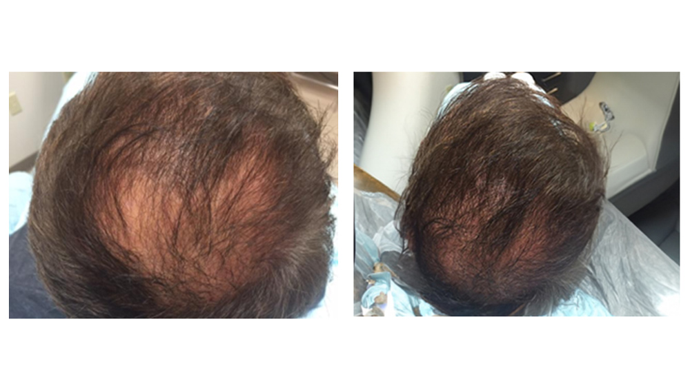 PRP for Hair Restoration before and after