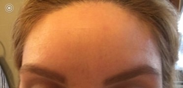 botox dysport and xeomin before and after 2