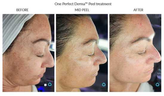 Perfect Derma Peel, The Perfect Derma Peel: Your Ultimate Solution for Flawless Skin