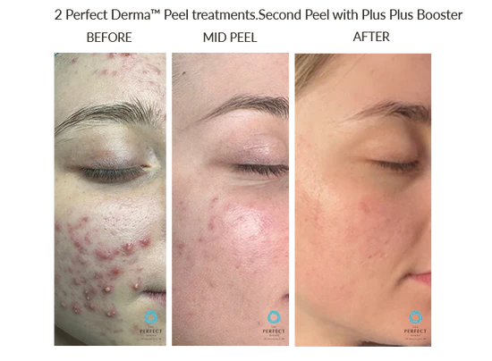 Perfect Derma Peel, The Perfect Derma Peel: Your Ultimate Solution for Flawless Skin