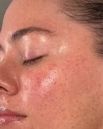 Microdermabrasion After