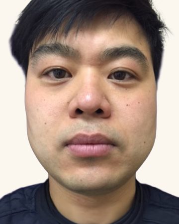 Jawline Sculpting Dysport