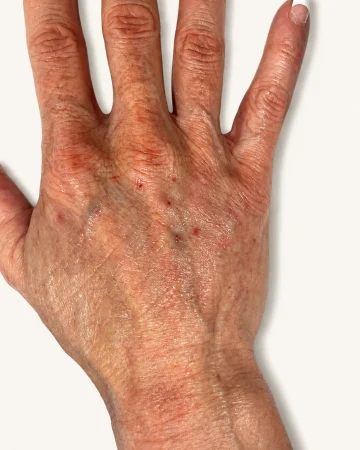 Hand filler - After