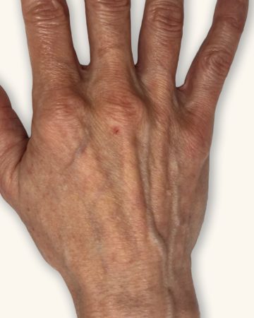 Filler to create a more youthful appearance of the hand