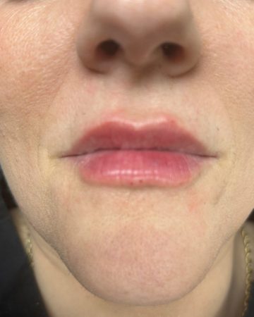 Lip Filler After