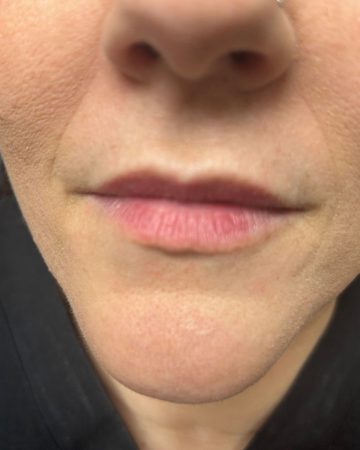 Lip Filler Example